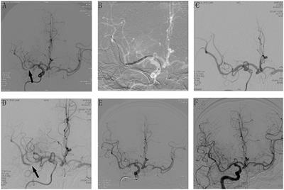 Safety and Efficacy of Tirofiban in Rescue Treatment for Acute Intracranial Intraprocedural Stent Thrombosis